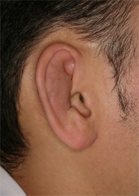 耳介偽嚢腫 じかいぎのうしゅ 天神形成外科クリニック