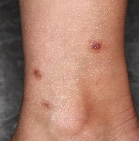 図１）虫刺されの跡に生じた炎症後色素沈着